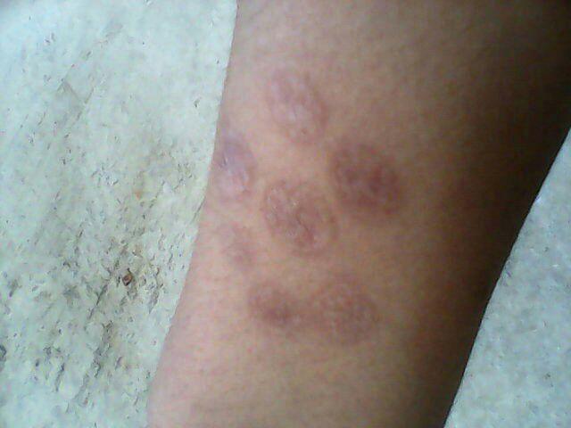 为什么有人会往身上烫烟疤