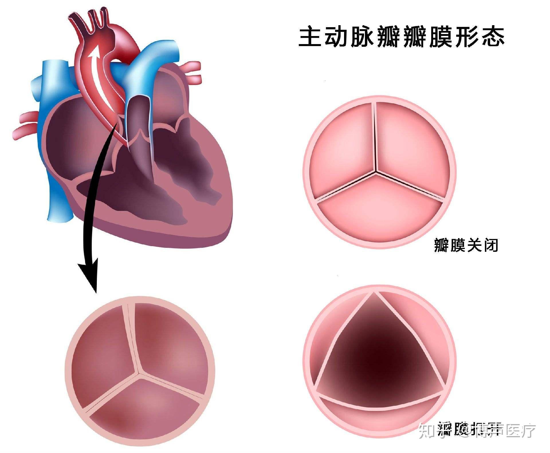合肥京东方医院首例 TAVR 手术成功，心脏主动脉瓣置换现已进入「介入换新」时代-医院汇-丁香园