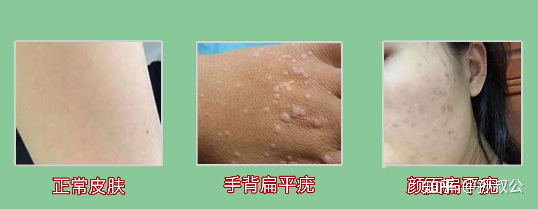如何判断皮肤上出现的是疣? - 知乎
