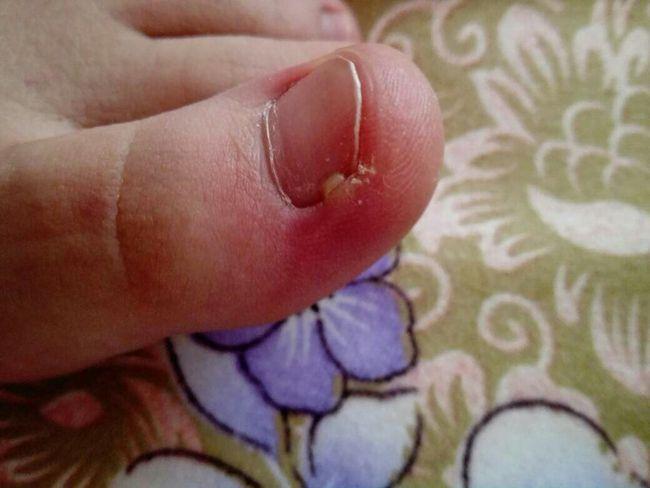 脚趾甲旁长肉芽疼怎么回事