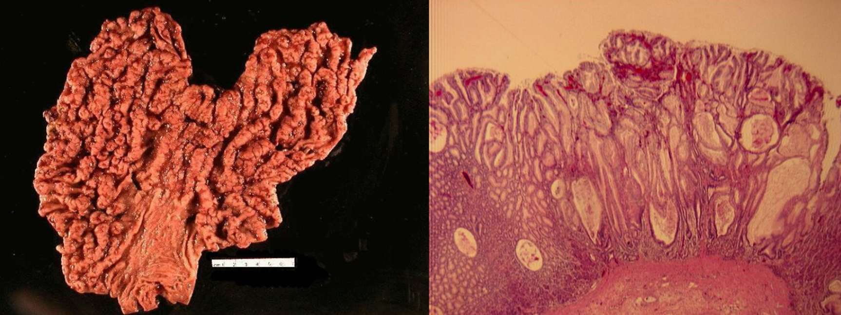 抗炎症食に従う