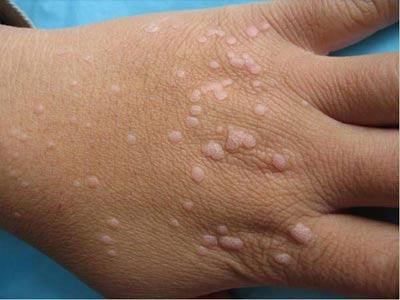 治疗扁平疣最好的药膏有哪些三种药膏治扁平疣效果好