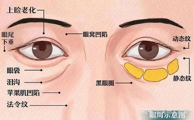 眼周抗衰怎么选:热玛吉、玻尿酸、胶原蛋白?这篇眼周抗衰攻略一定要看! - 知乎