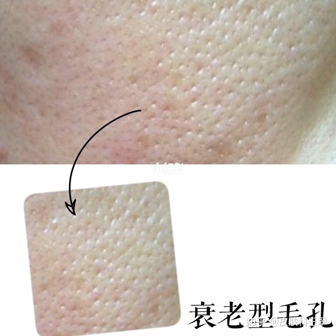 毛孔粗大的原因