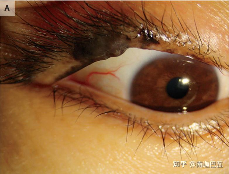 看图识病75|睑结膜和眼睑黑色素瘤