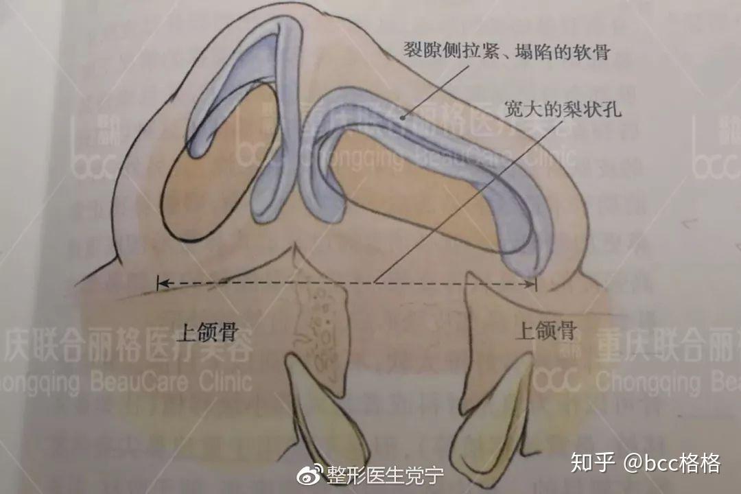 有一些病人,由于梨状孔很宽,鼻翼软骨牵拉太紧,没有办法将鼻翼软骨弓