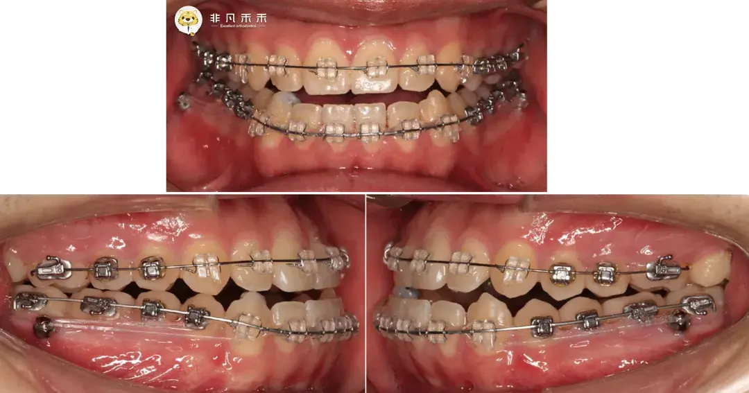 『正畸病例』地包天,二次矫正病例 1 例