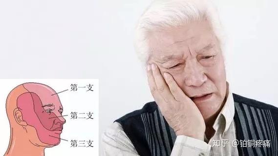 痛痛痛 生命不能承受之痛 三叉神经痛 知乎