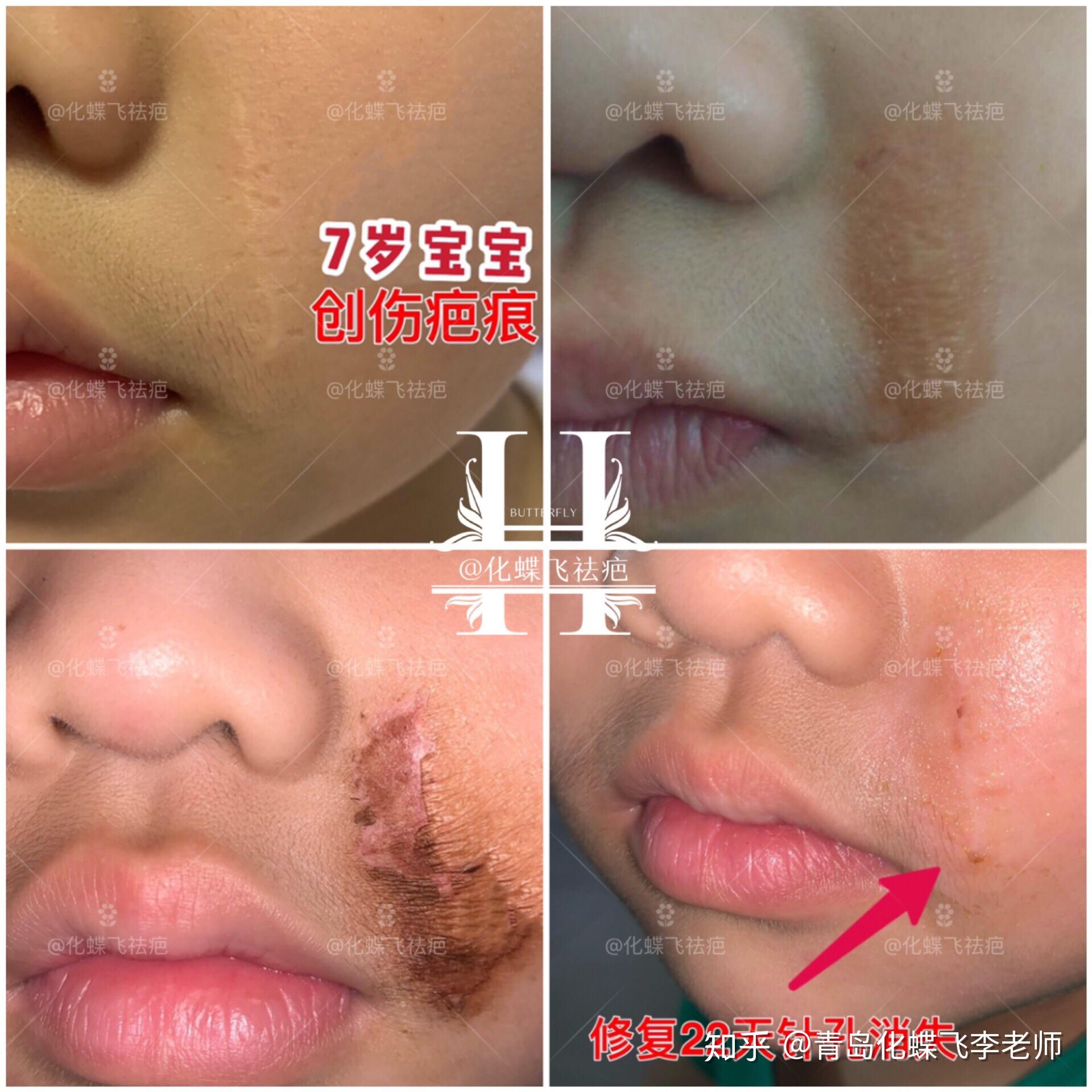 使用中药进行疤痕修复,小朋友新陈代谢就是快,代谢两次,恢复的非常好