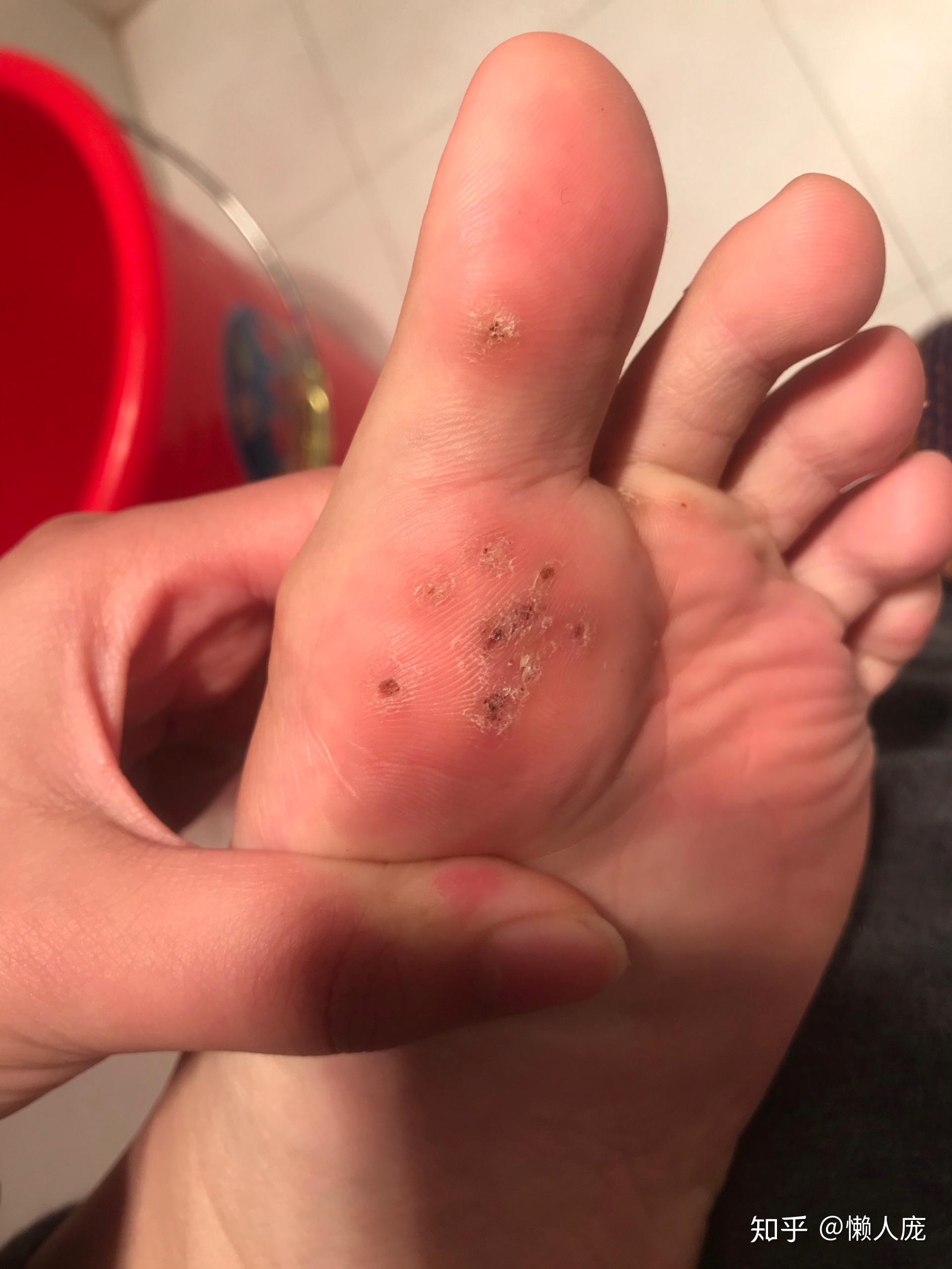 脚上感染长了疣怎么弄
