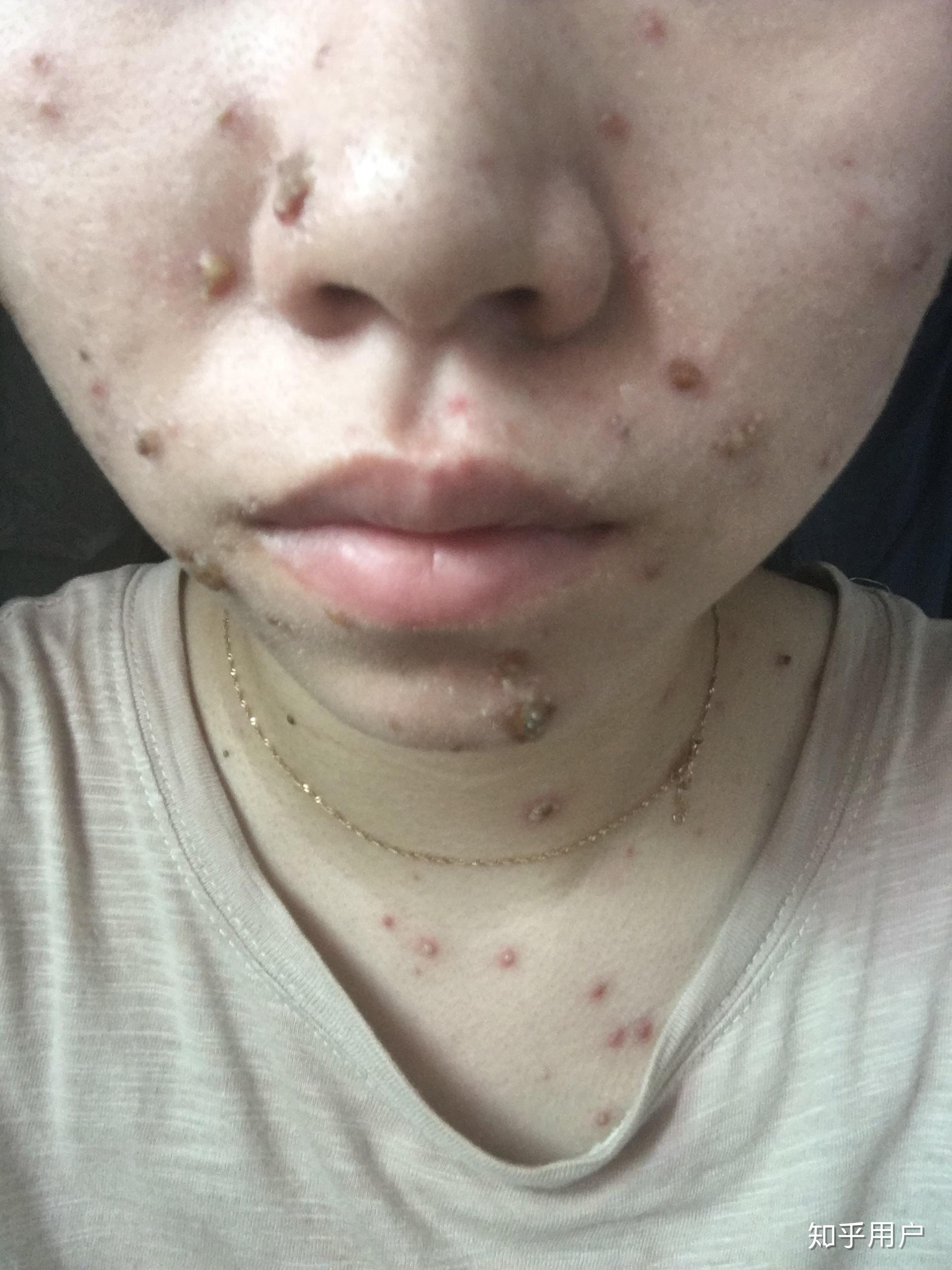 成人长水痘是什么样的经历