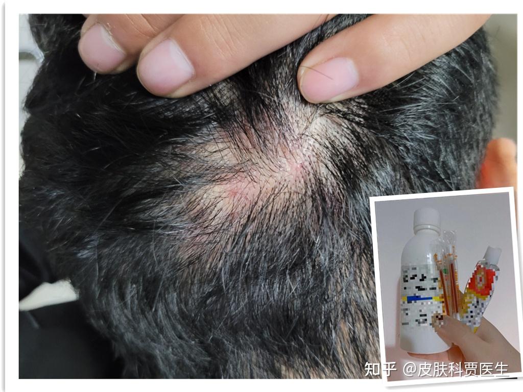 头皮上老是长痘痘扣了是个血痂要不然就是按着疼的包这是啥玩意啊
