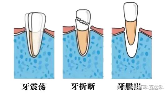 一般情况下,根据牙齿受伤程度主要分为三种:牙震荡,牙折断,牙脱出.