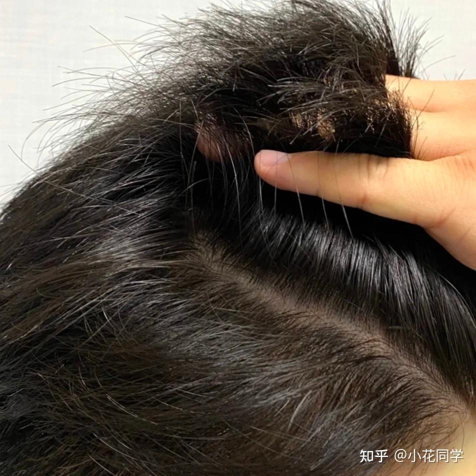 男生感觉自己头皮屑太多洗不干净，有啥简单高效一步到位的去屑止痒方法吗？ - 知乎