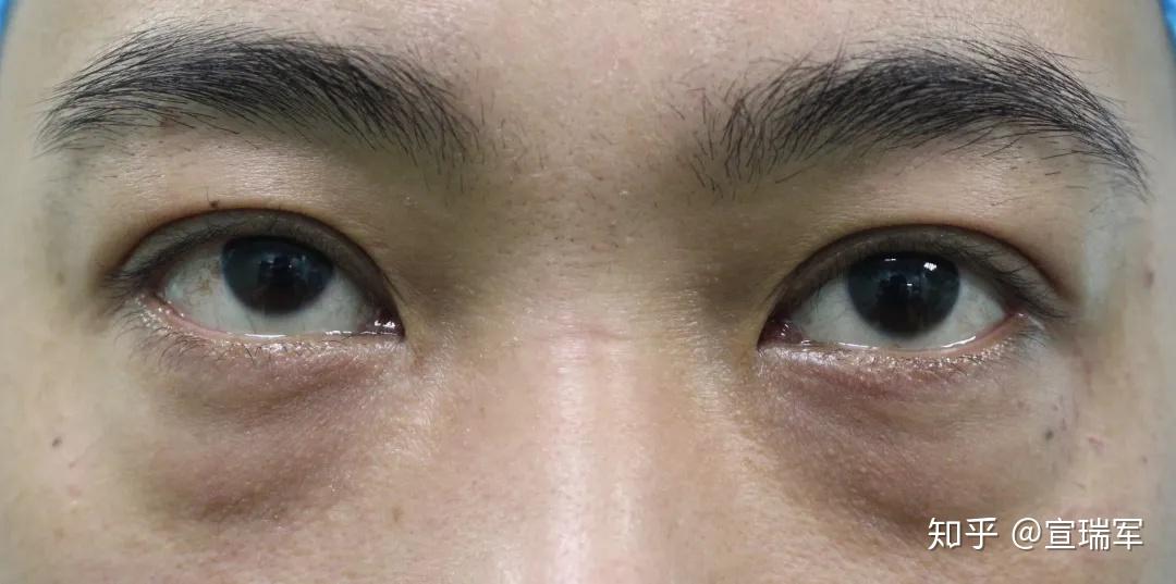 眼袋大面中凹陷的脸该如何改善