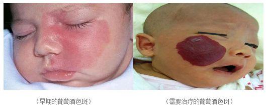 宝宝的胎记或痣真不用管吗?错!有这4种情况赶紧就医 - 知乎
