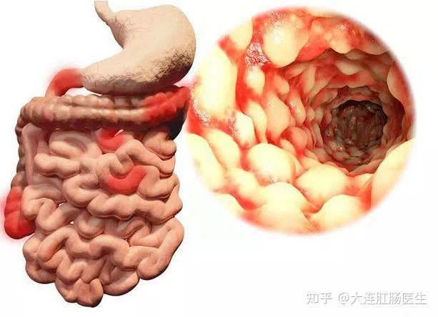 大連陽光肛腸醫院肛門墜脹便不盡找到元兇從源頭入手