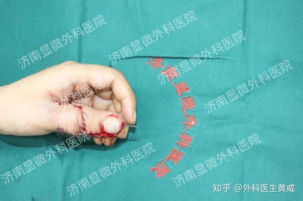 手指再造就是脚趾搬家no再造手指和保留脚趾不再是二选一