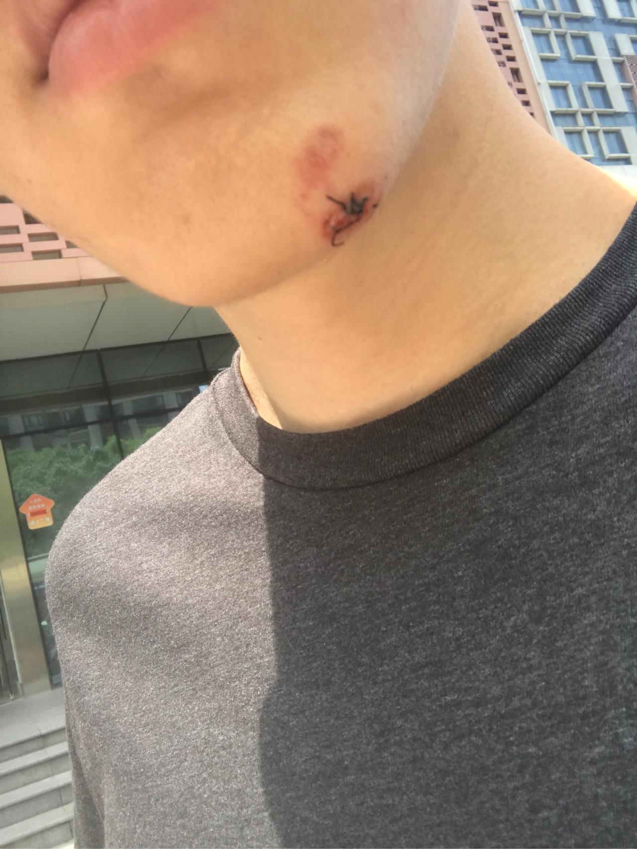 摔了下巴缝了好几针紧急去医院缝了以后会留疤吗我