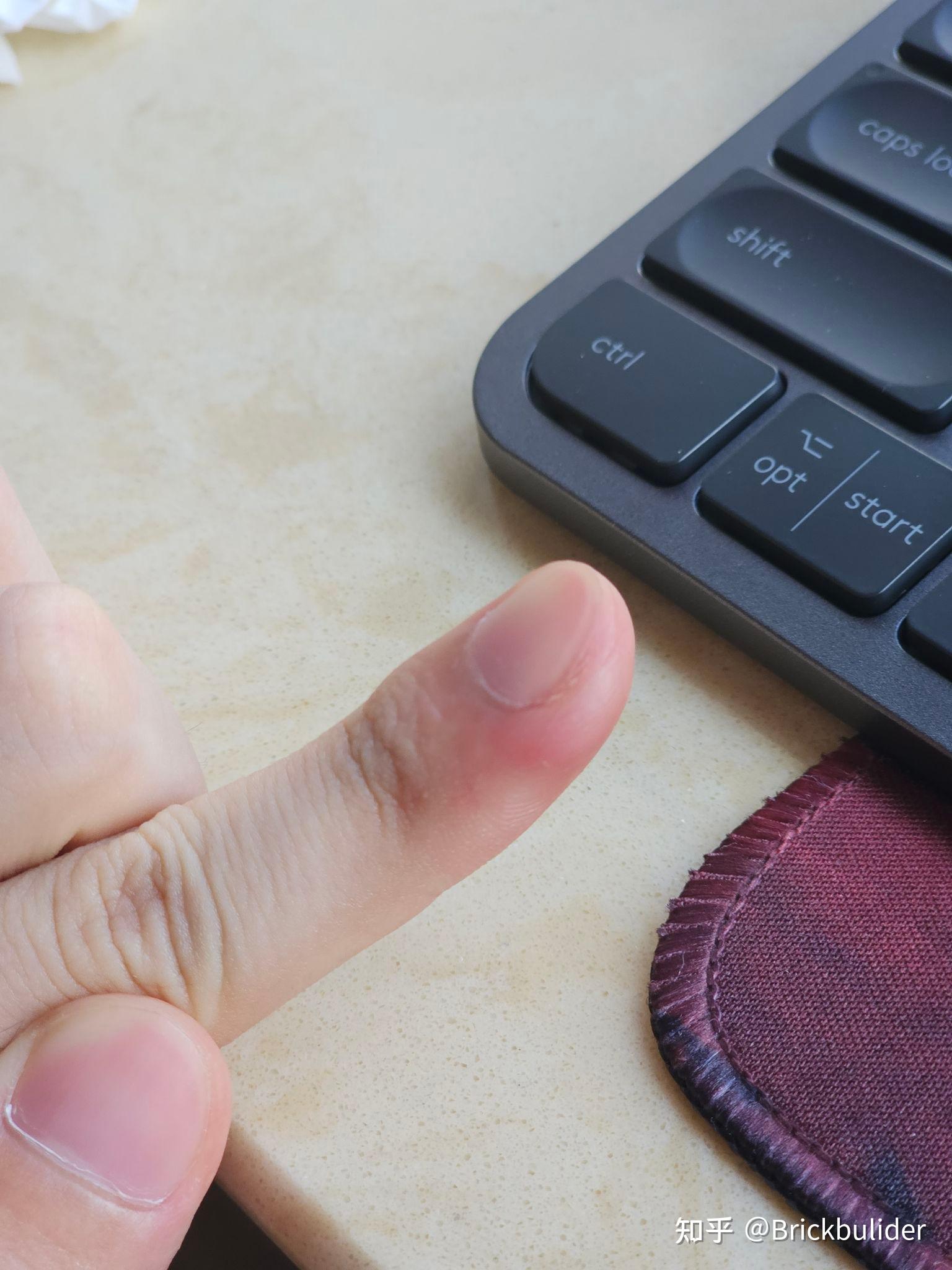 包含手莫名其妙的肿了因为什么的词条