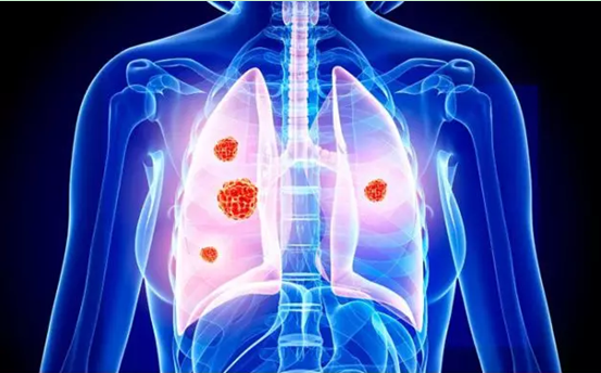 21岁女咳嗽半年确诊肺癌病逝医生肺腺癌未必与吸烟有关