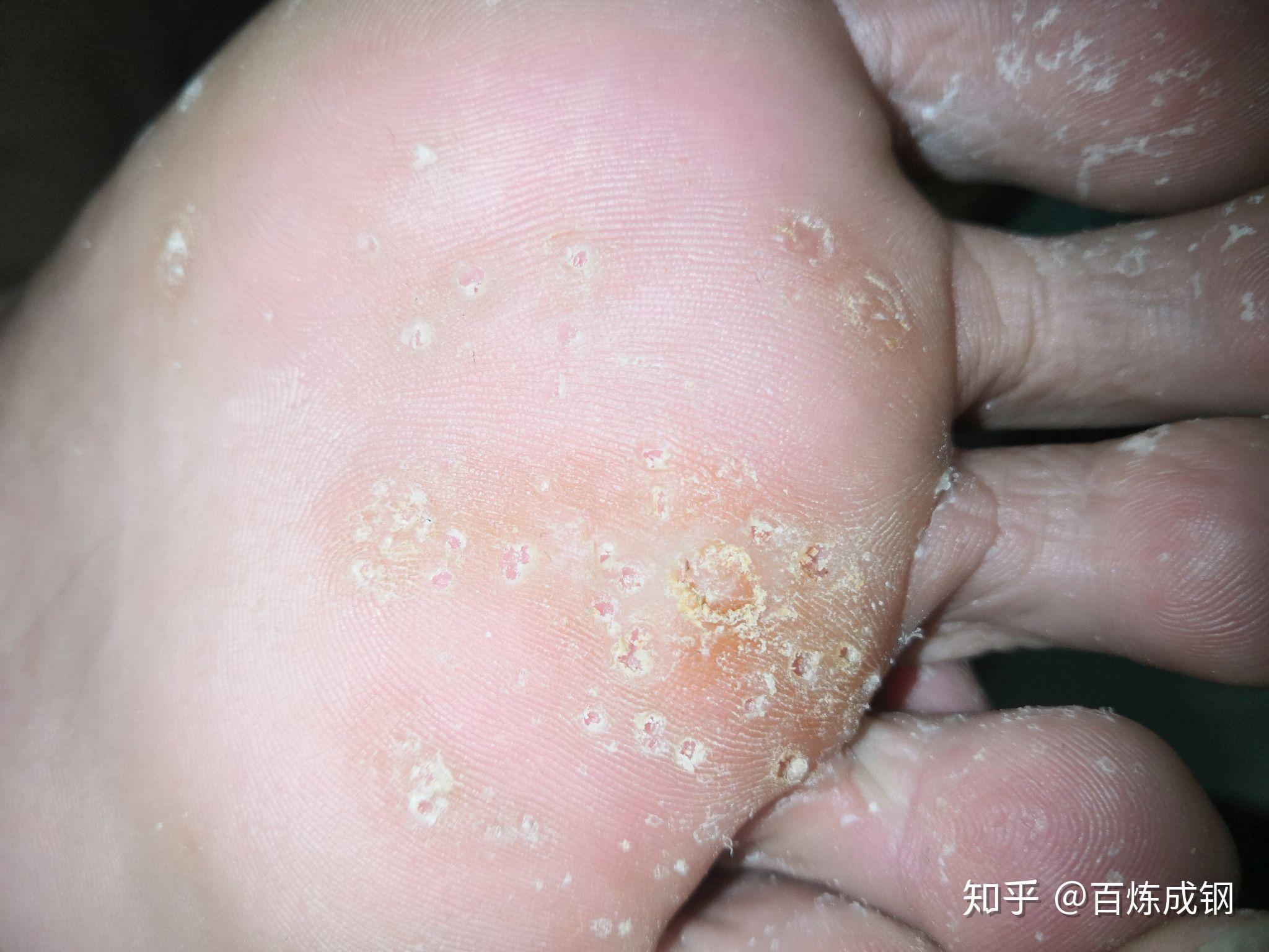 跖疣治疗第24天