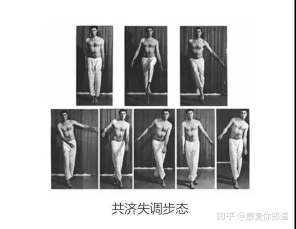 体态矫正——常见异常步态 - 知乎