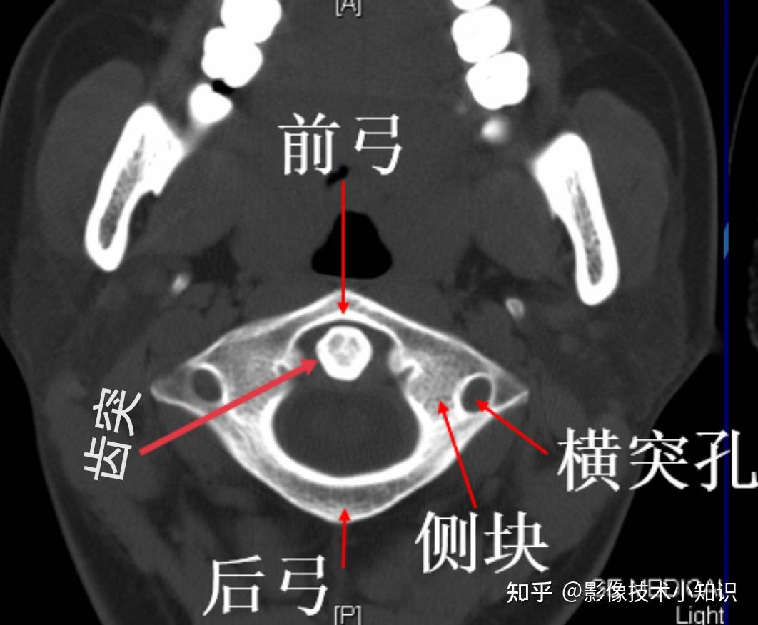 寰枕关节是:两侧枕髁与寰椎侧块的上关节凹构成的联合关节