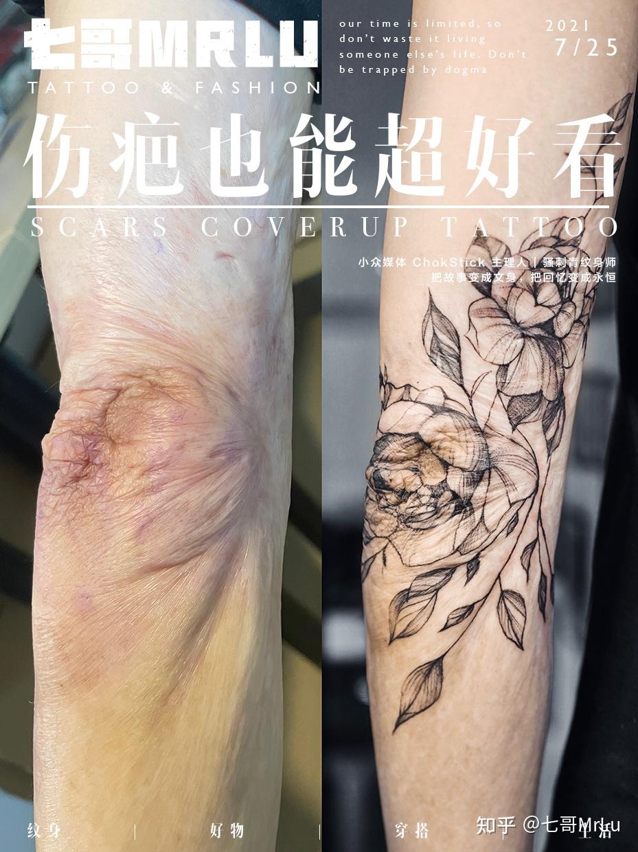 你们的疤痕最后都是怎样好的？ - 知乎