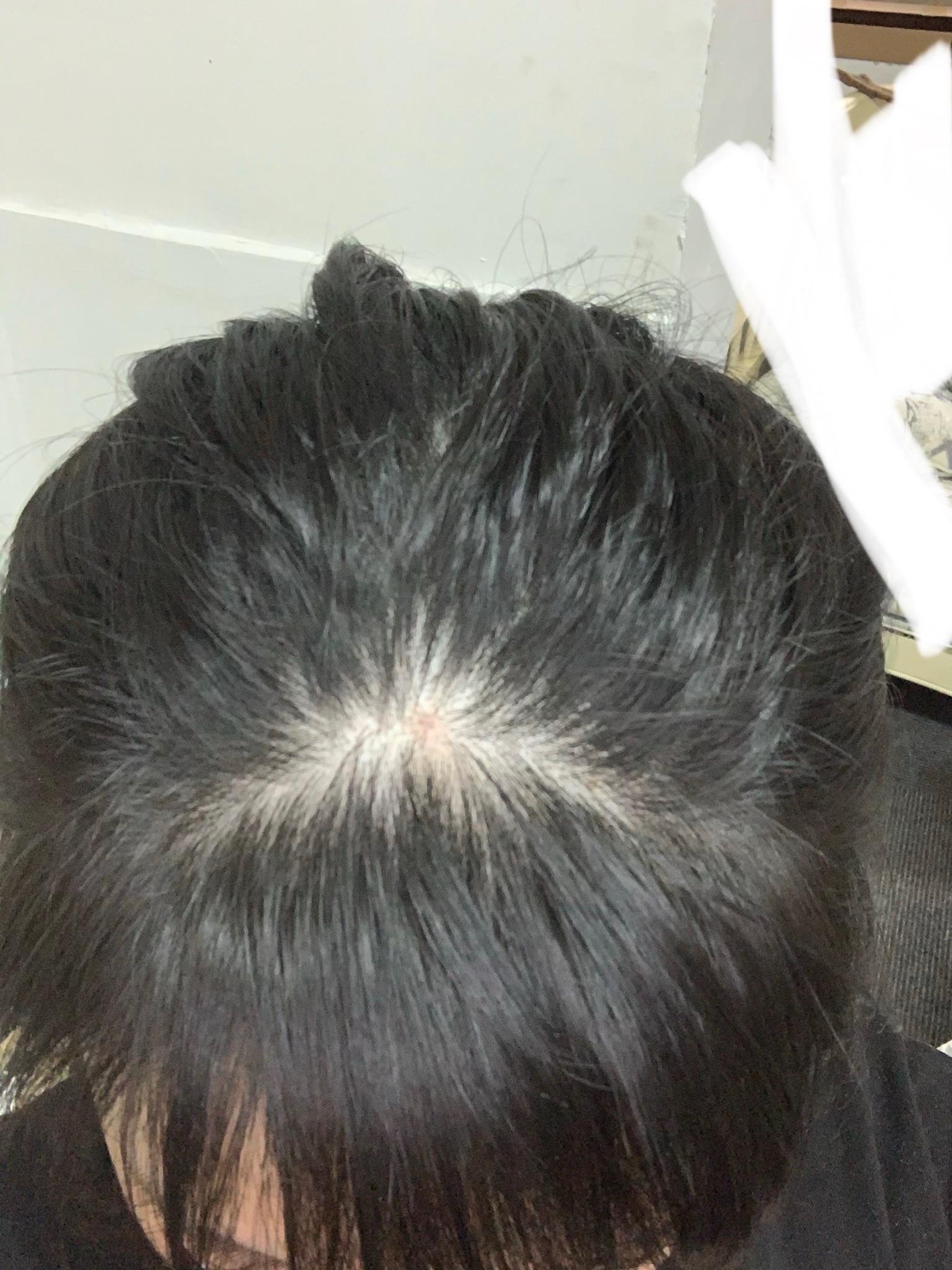 为什么我发量挺多的,但是就头顶刘海的分界线那里感觉很秃? - 知乎