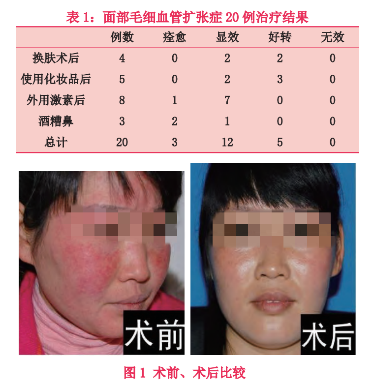 文献整合强脉冲光治疗面部毛细血管扩张及联合疗法的应用