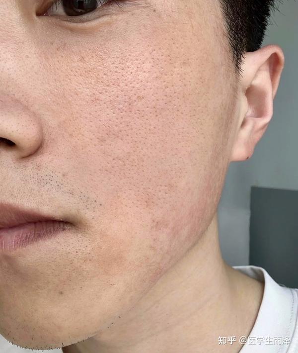 【大毛孔必看】为什么皮肤科医生强烈建议你,毛孔粗大、邋遢,只差能塞进芝麻的时候,乳糖酸可以改善?教你几招,直击“毛坑”问题,拒绝试错! - 知乎