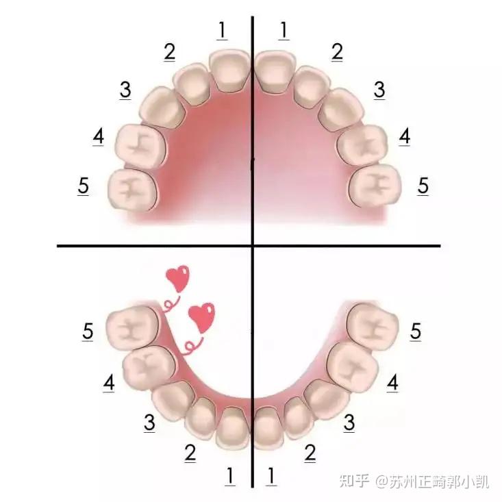 牙齿正畸 拔掉4颗4号牙好还是拔掉1颗6号牙和3颗4号牙好? 