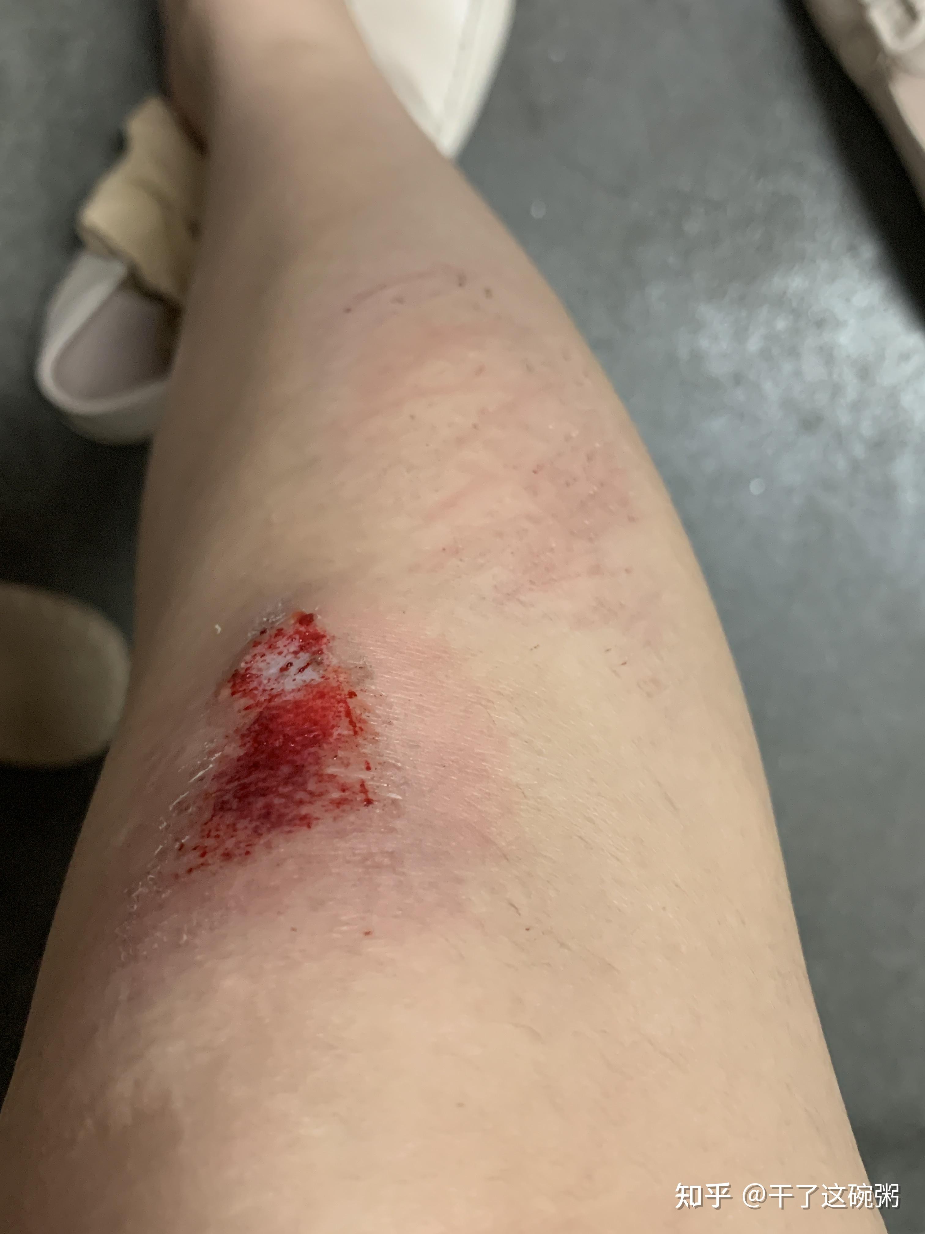 记录膝盖擦伤到痊愈的过程