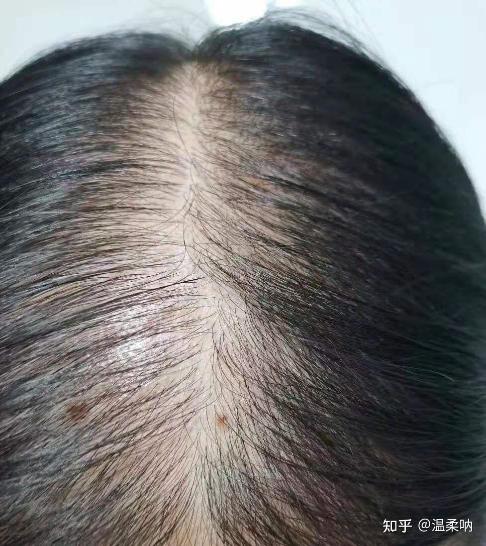 脑溢性脱发好了终于恢复正常了