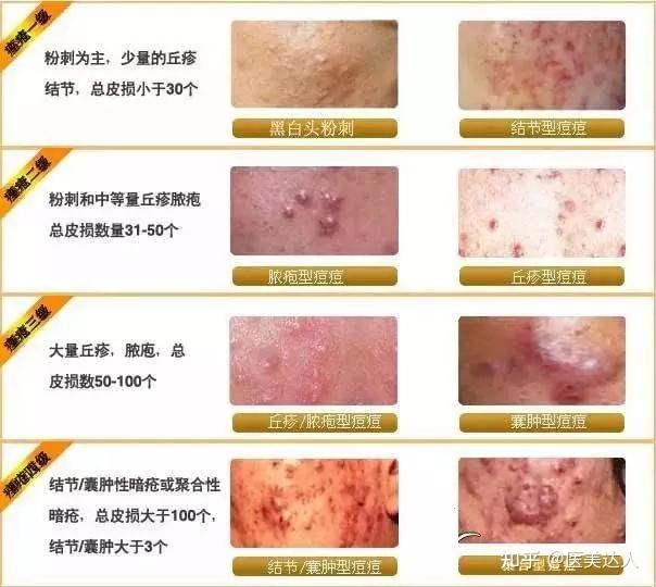 如何改善痘痘肌?芙清面膜,凝胶,博乐达,白芙芙,绿芙芙真有用!