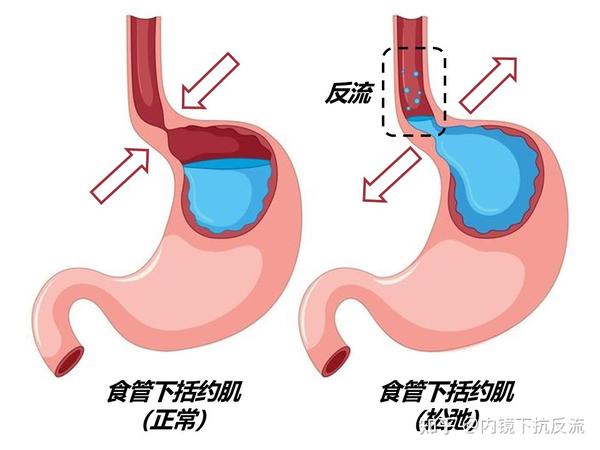 胃食管反流病的病因与发病机制 - 知乎