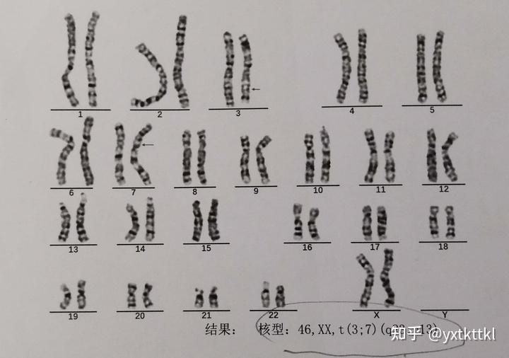遗传咨询之平衡易位案例 - 知乎