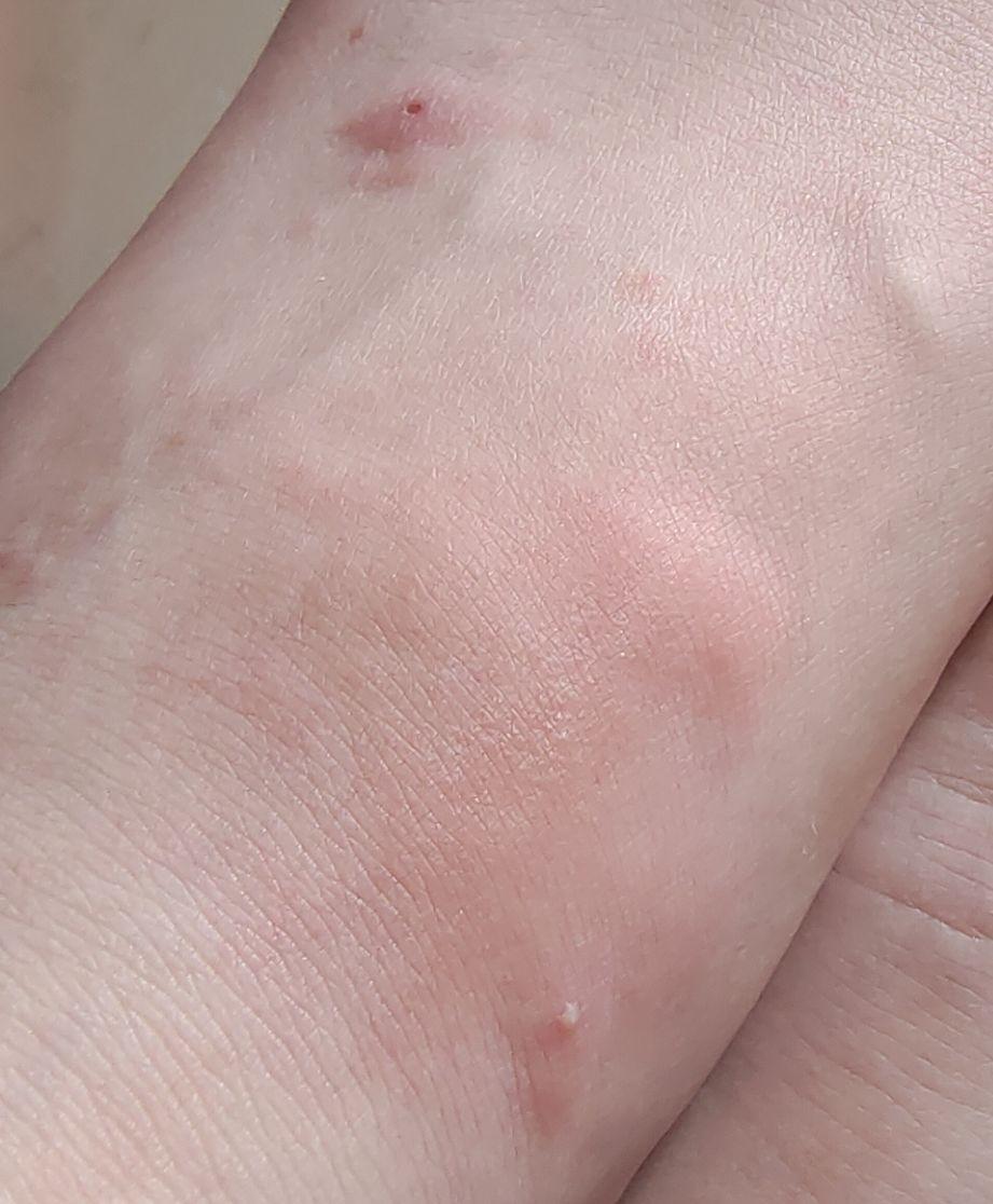 被蚂蚁咬之后用药什么更有效呢? - 知乎