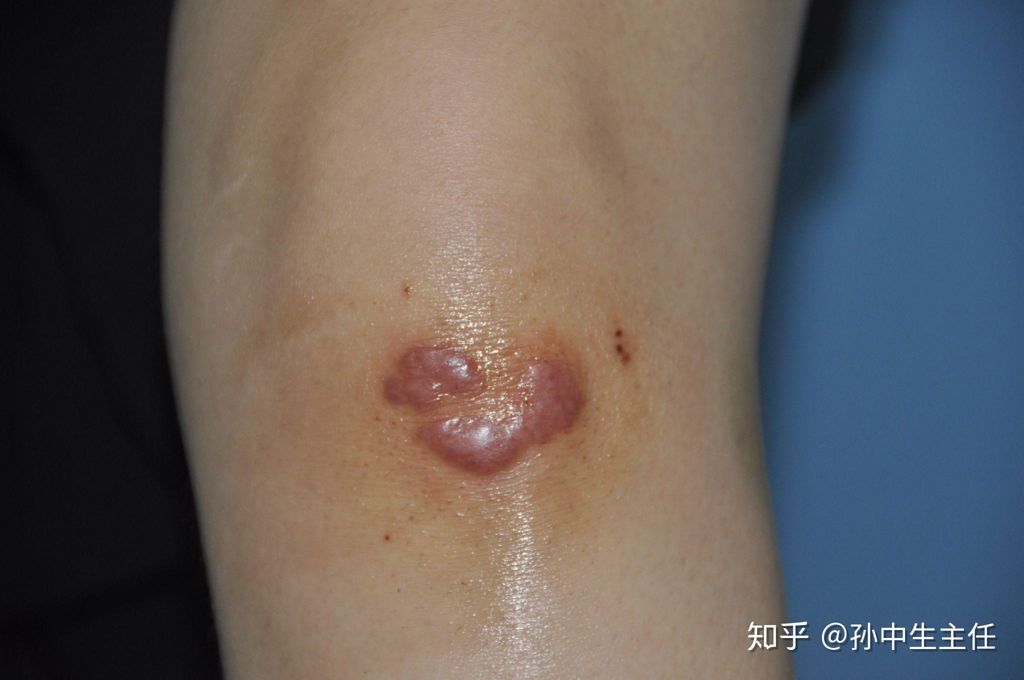 疤痕修复手术如何选择合适时机