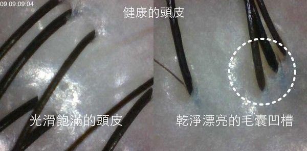 种头发多少钱一个毛囊