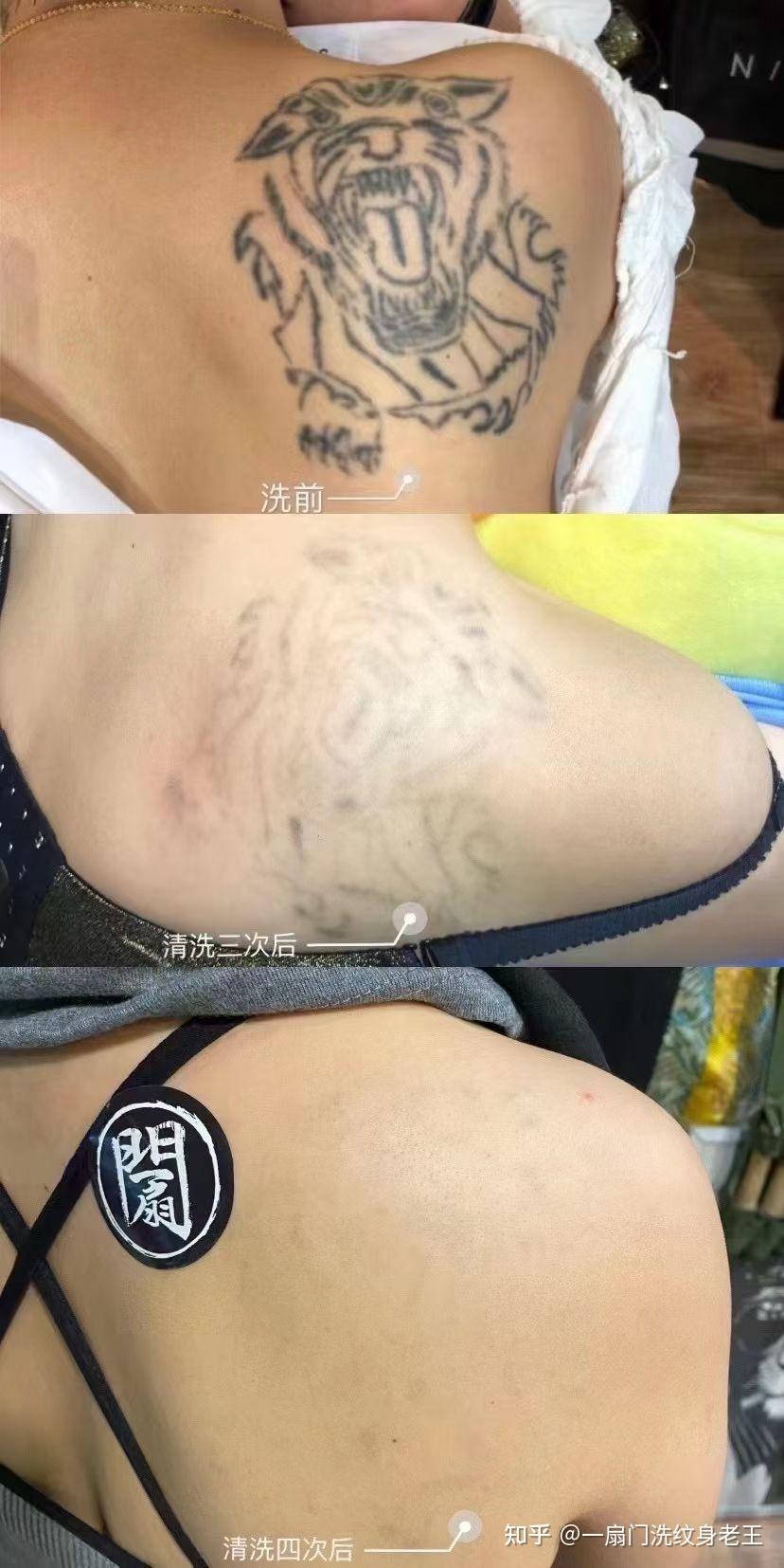 杭州洗紋身哪裡好無痛不留疤的那種