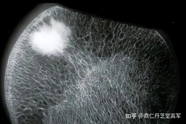 骨岛是什么病?