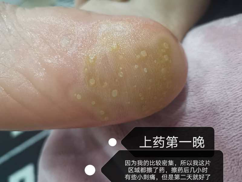 跖疣的自愈性大吗? - 知乎