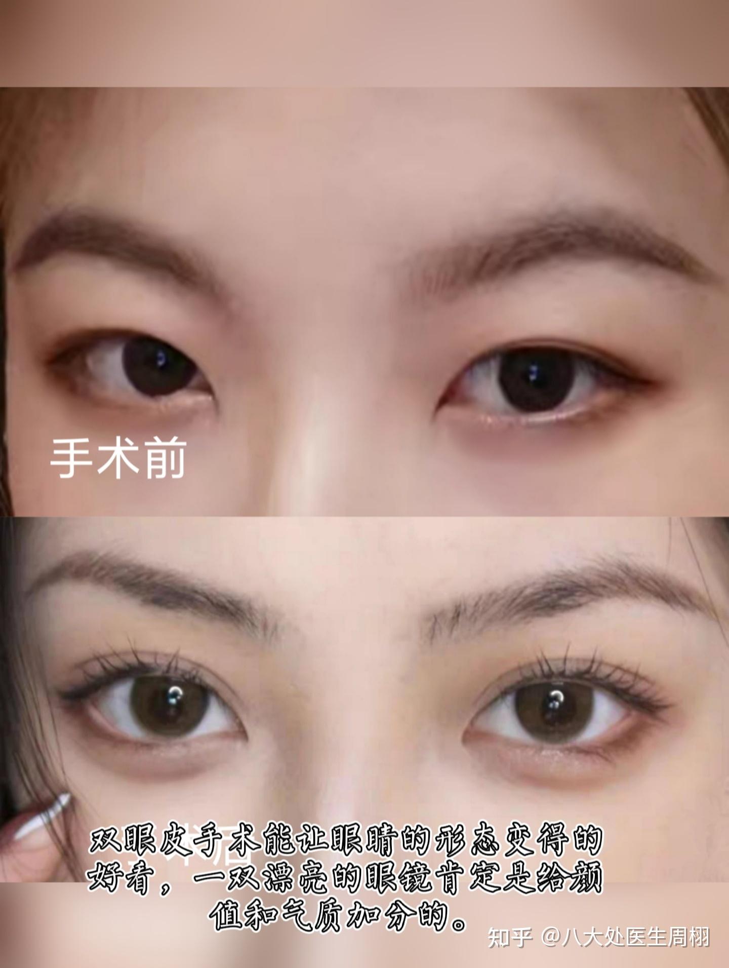 全切双眼皮案例分享