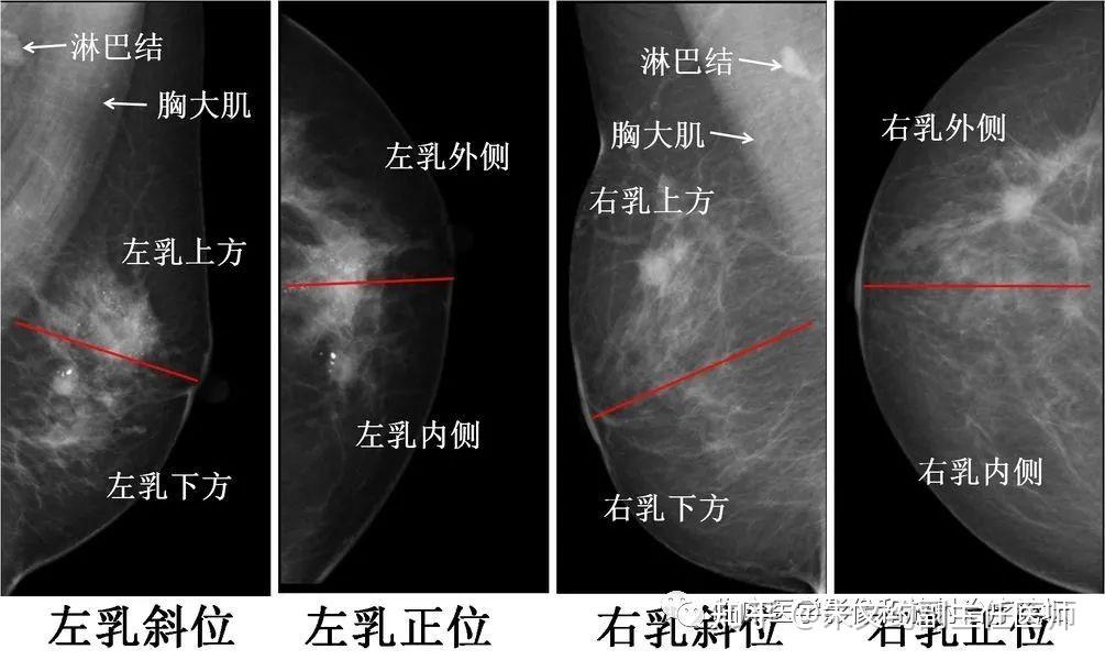 乳腺x线摄影检查及诊断 知乎 