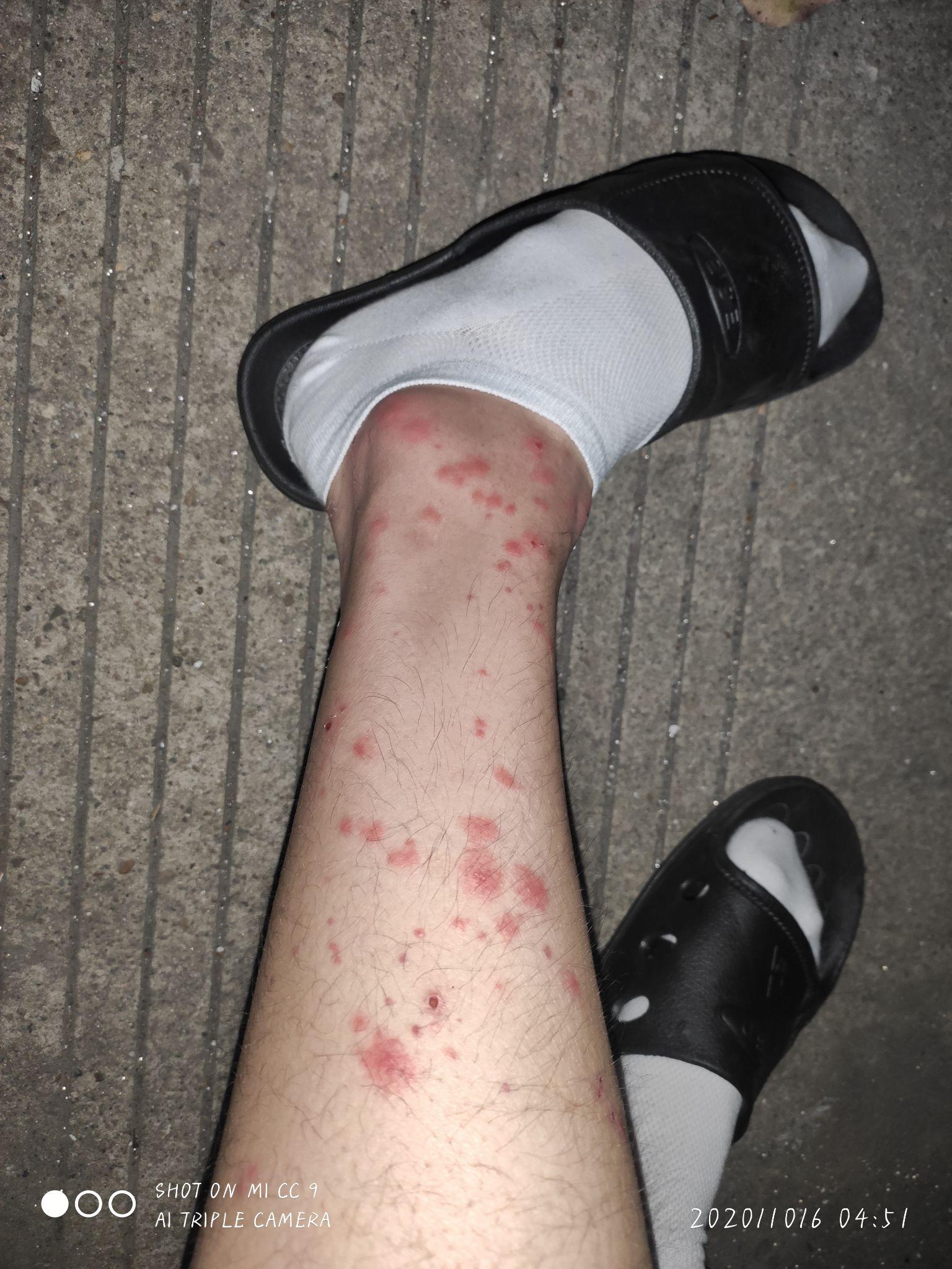 被跳蚤咬的全身都是包是什么样的感受