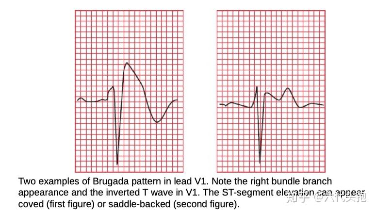 心电图brugada波样改变图片