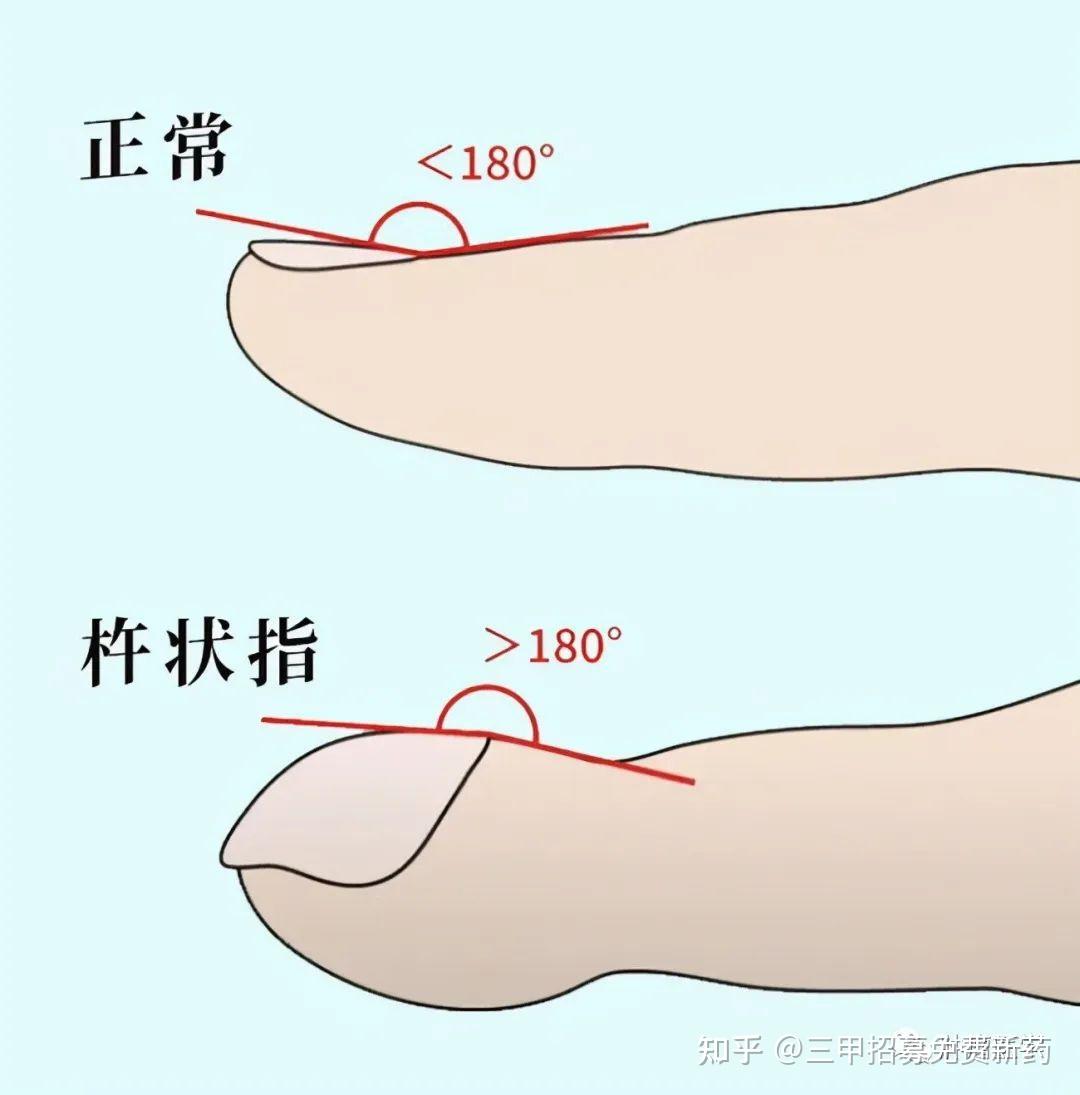 从手指也能看出肺癌?提醒:手指出现5个异常,赶紧排查病因 - 知乎