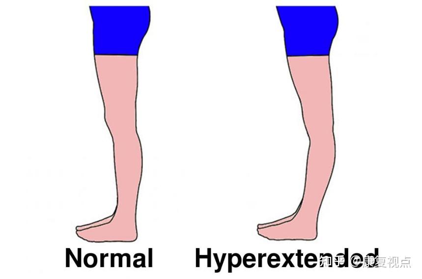 步态分析，详解人类步态和异常步态 - 知乎